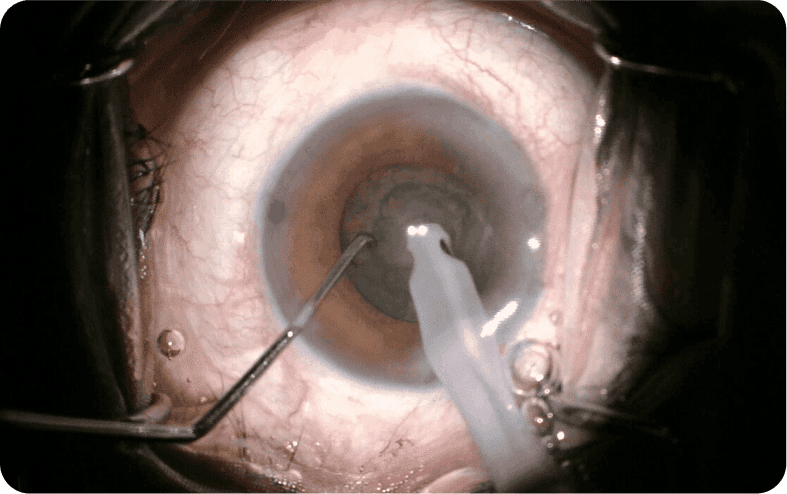 Phacoemulsification cataract surgery in progress