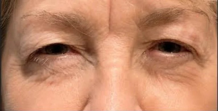 Upper eyelid blepharoplasty before repair