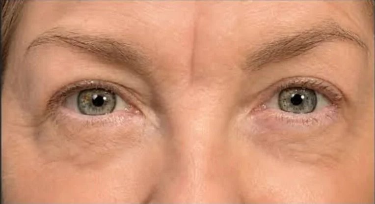 Upper eyelid blepharoplasty after repair