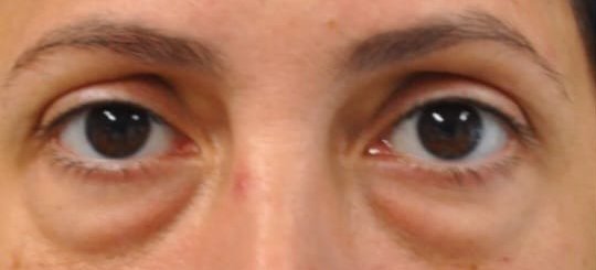 Lower eyelid blepharoplasty before repair