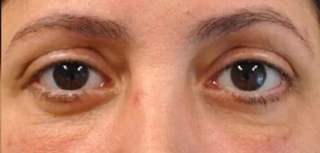 Lower eyelid blepharoplasty after repair