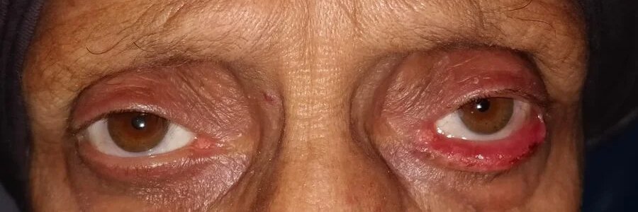 Ectropion before repair