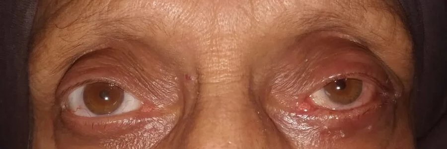 Ectropion after repair