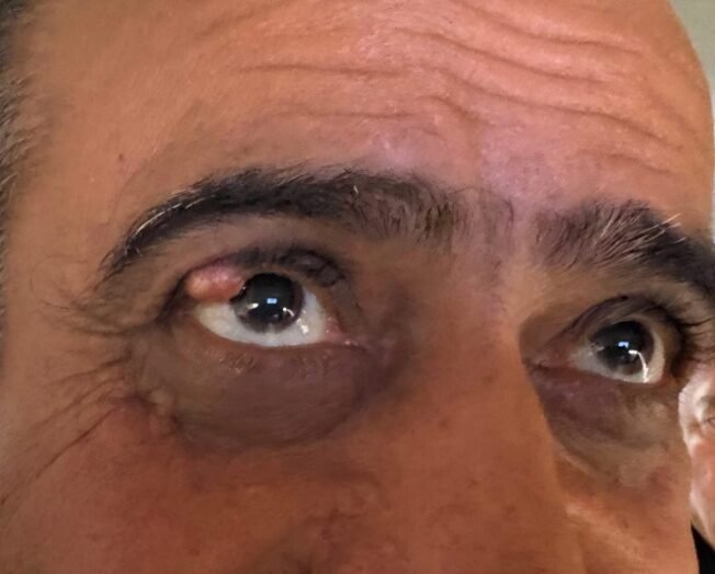 Upper eyelid benign tumour before removal