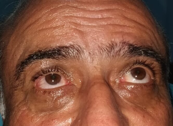 Upper eyelid after tumour removal