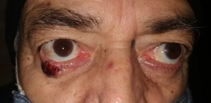 Lower eyelid malignant tumour before removal
