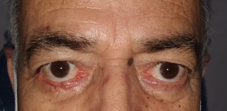 Lower eyelid after tumour removal and reconstruction