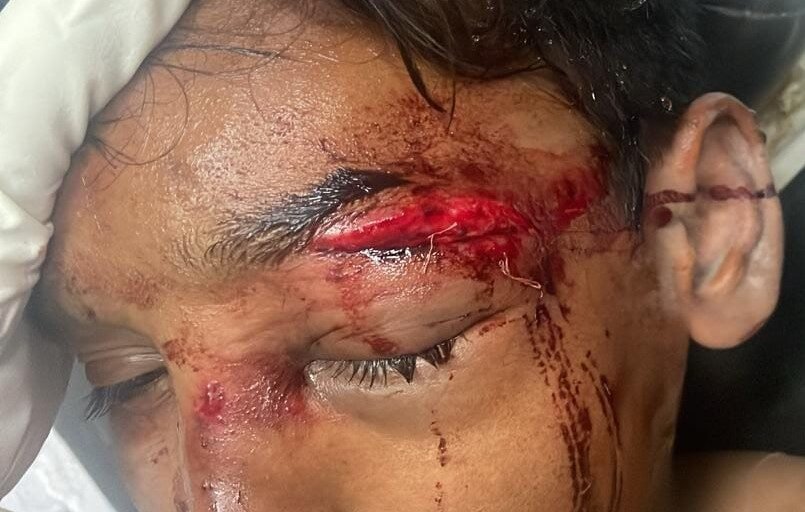 Upper lid laceration before repair