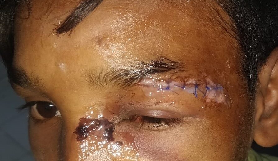 Upper lid after laceration repair
