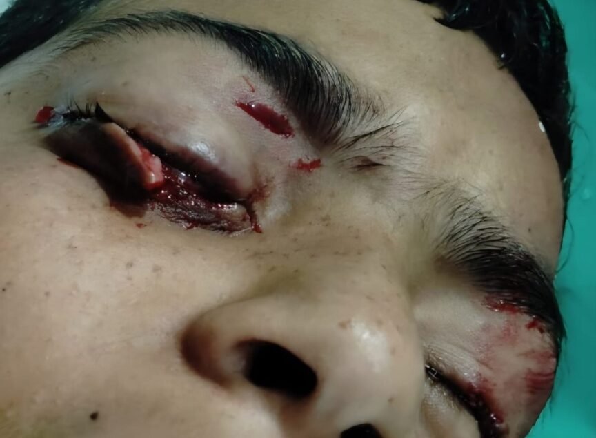 Lower lid laceration involving the lower canaliculus