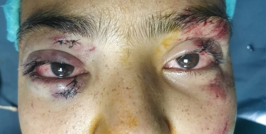 Lower lid after repair with lacrimal intubation