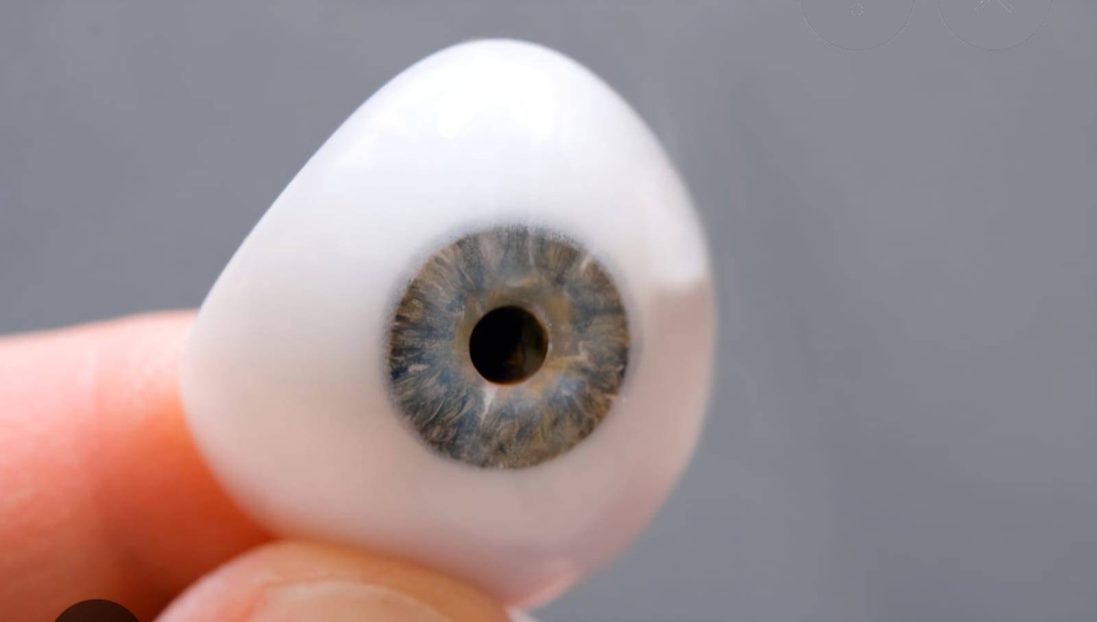 Ocular prosthesis (artificial eye) result