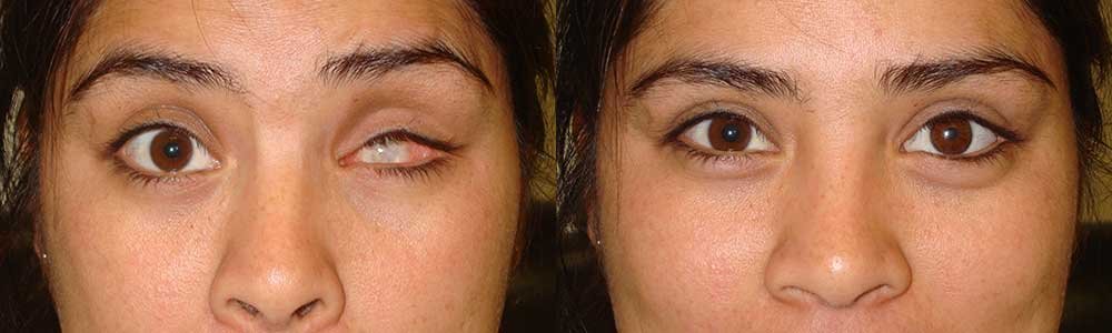 Ocular prosthesis fitting