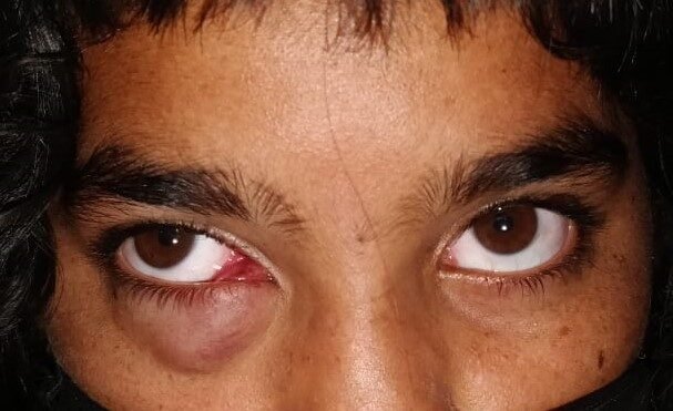 Orbital tumour before surgery — case 1