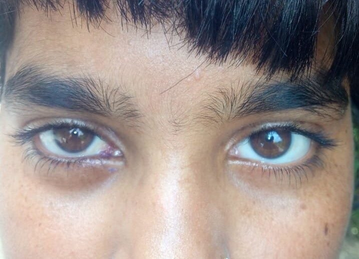 After orbital tumour surgery — case 1