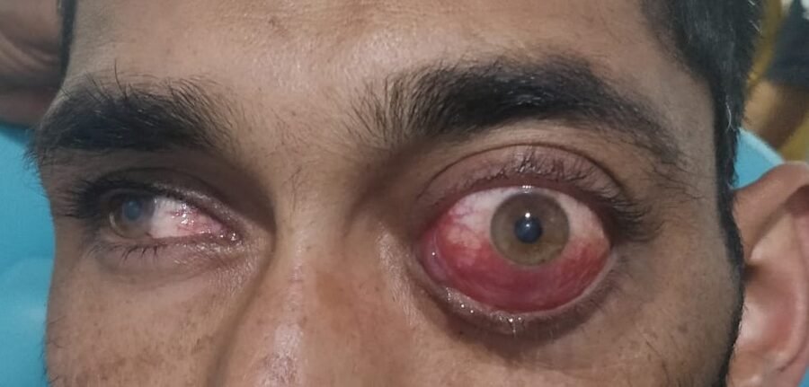 Orbital tumour before surgery — case 2