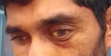 After orbital tumour surgery — case 2