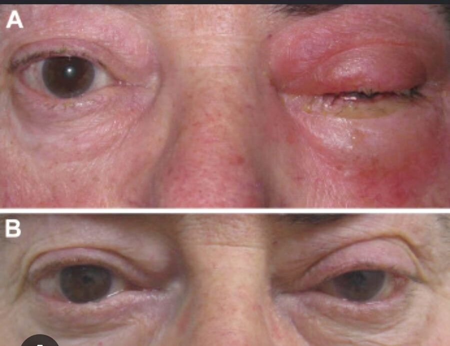 Orbital infection with eyelid swelling