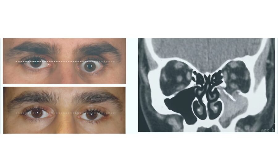 Orbital fracture assessment