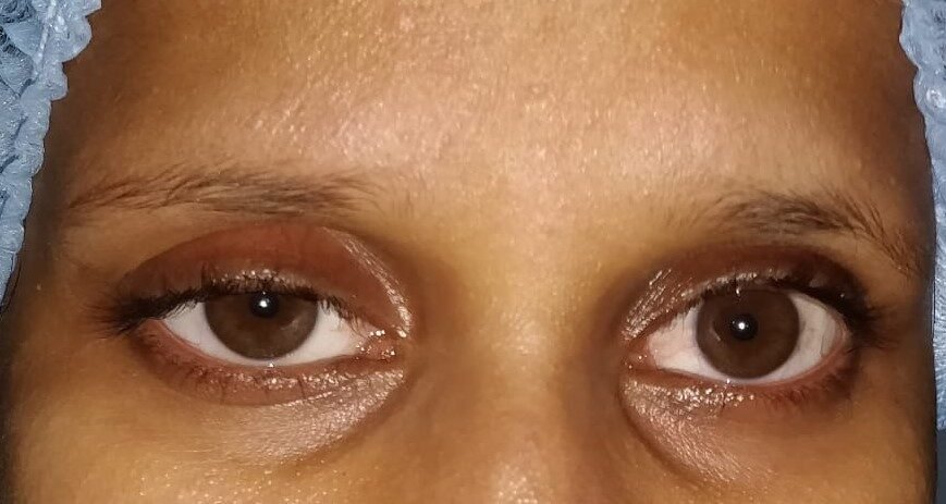Acquired ptosis before surgery