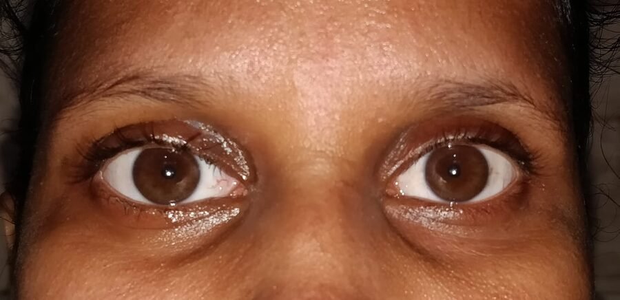 Acquired ptosis after surgery