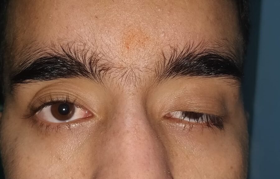 Congenital ptosis before surgery