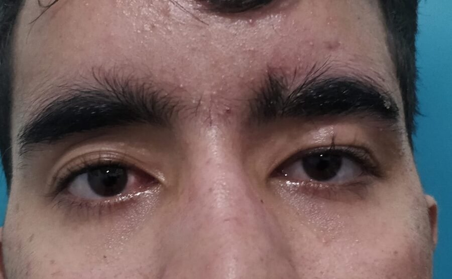 Congenital ptosis after surgery