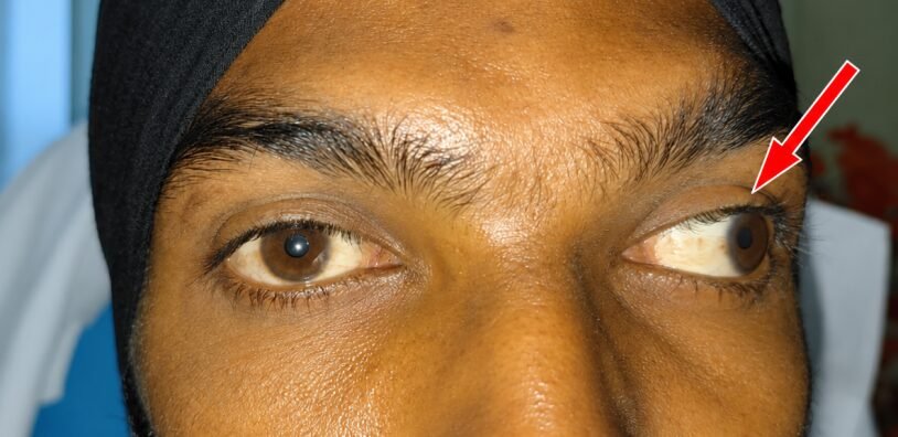 Divergent squint before surgery