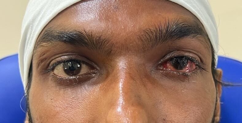 After squint surgery